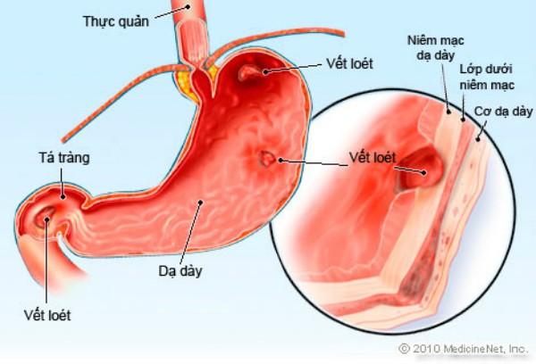 Tức giận dễ gây ra loét dạ giày.